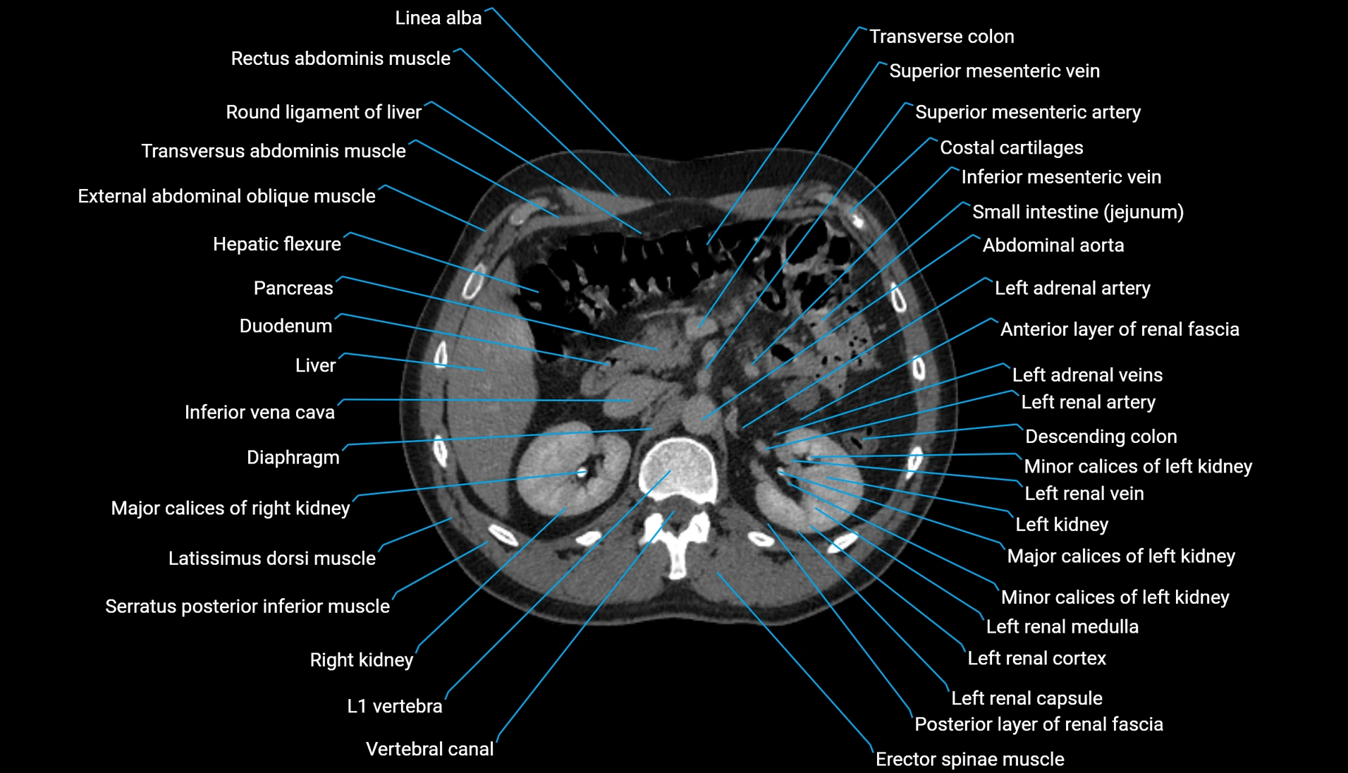 CT urogram axial cross sectional anatomy  labelled radiology image-00092.webp